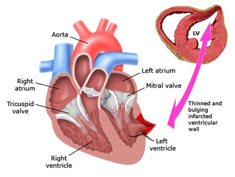 lv bw|Left ventricular pseudoaneurysm versus aneurysm a diagnosis .